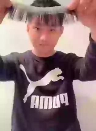 Amazing Hair Transplant Ever You Seen