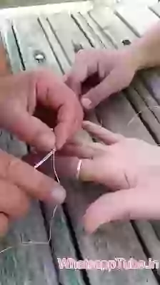 Solution For Stuck Finger Ring